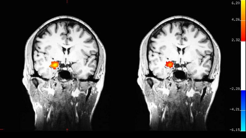 Brain activity comparison before and after meditation