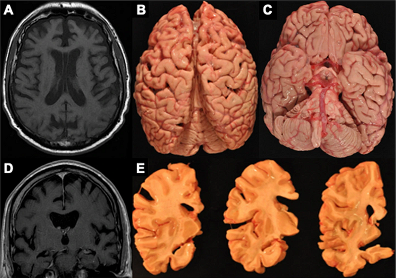 MRI images showing CTE effects